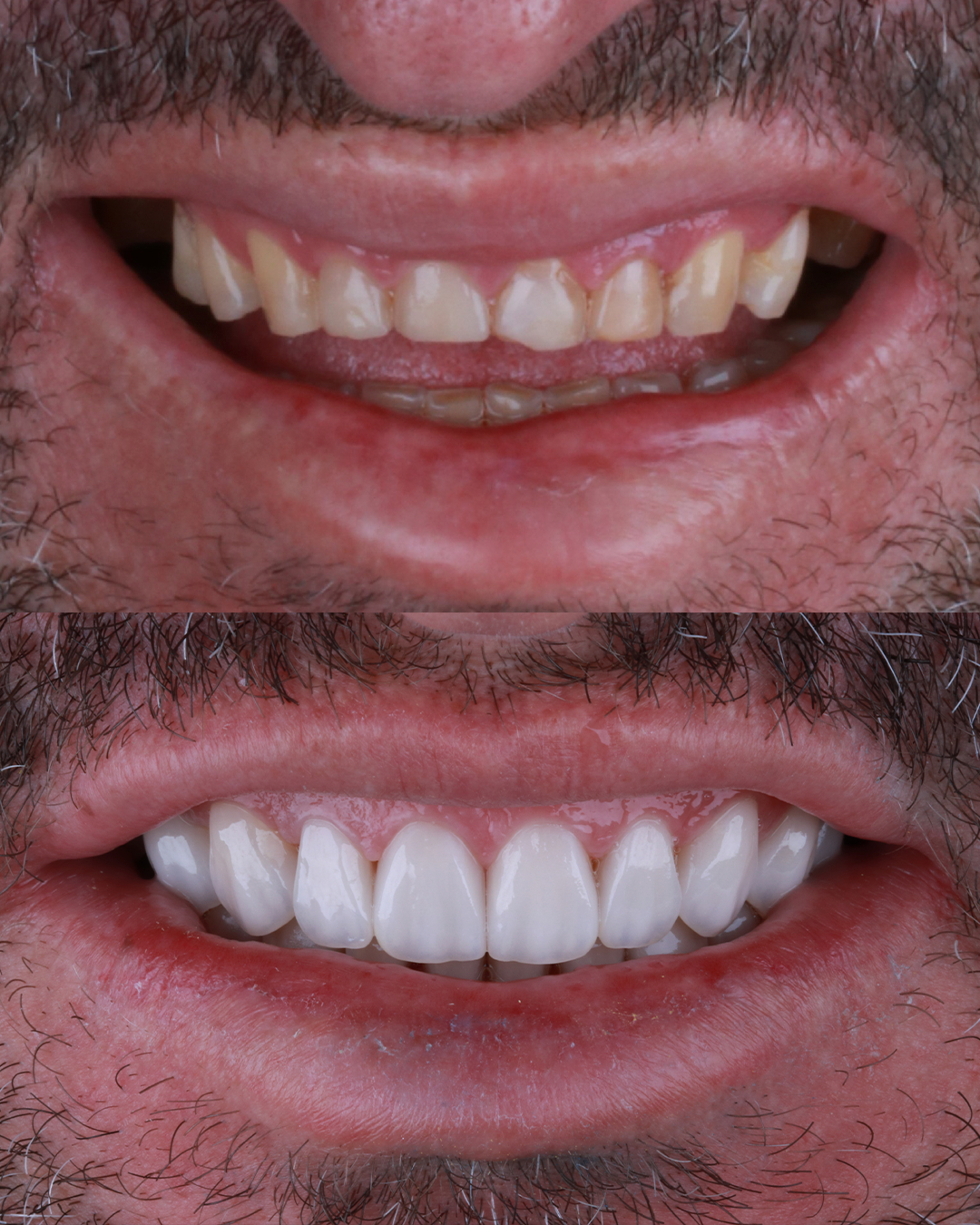Sorriso premium com lentes em cerâmica